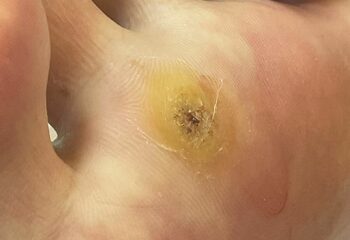 Удаление подошвенных бородавок (шипиц)