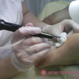 Удаление новообразований