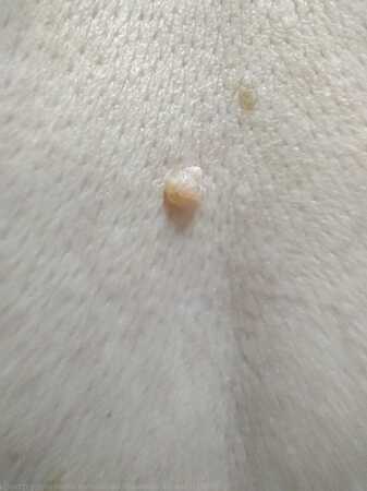 Внутридермальный меланоцитарный невус спина