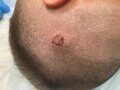 Удаление доброкачественного новообразования на коже головы с последующим наложением шва и отправкой на гистологическое исследование.